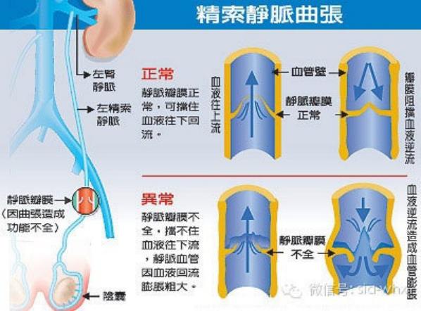 關(guān)于2021年征兵精索靜脈曲張標(biāo)準(zhǔn)的探討，2021年征兵精索靜脈曲張標(biāo)準(zhǔn)深度解析